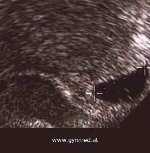 ultraschallbild_6te_schwangerschaftswoche